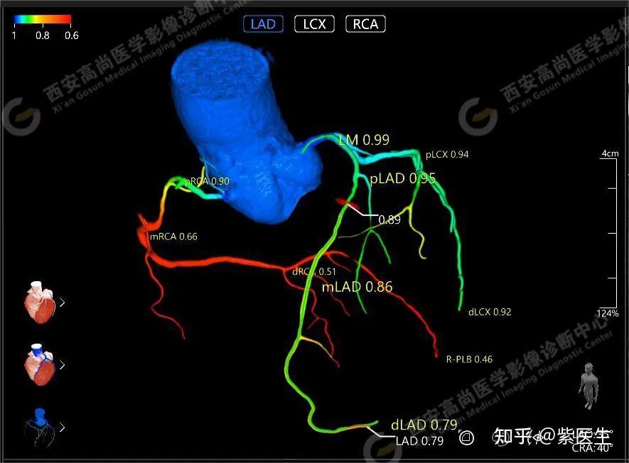 高尚医学影像之冠状动脉ct血流储备分数ai定量分析（ct Ffr） 知乎