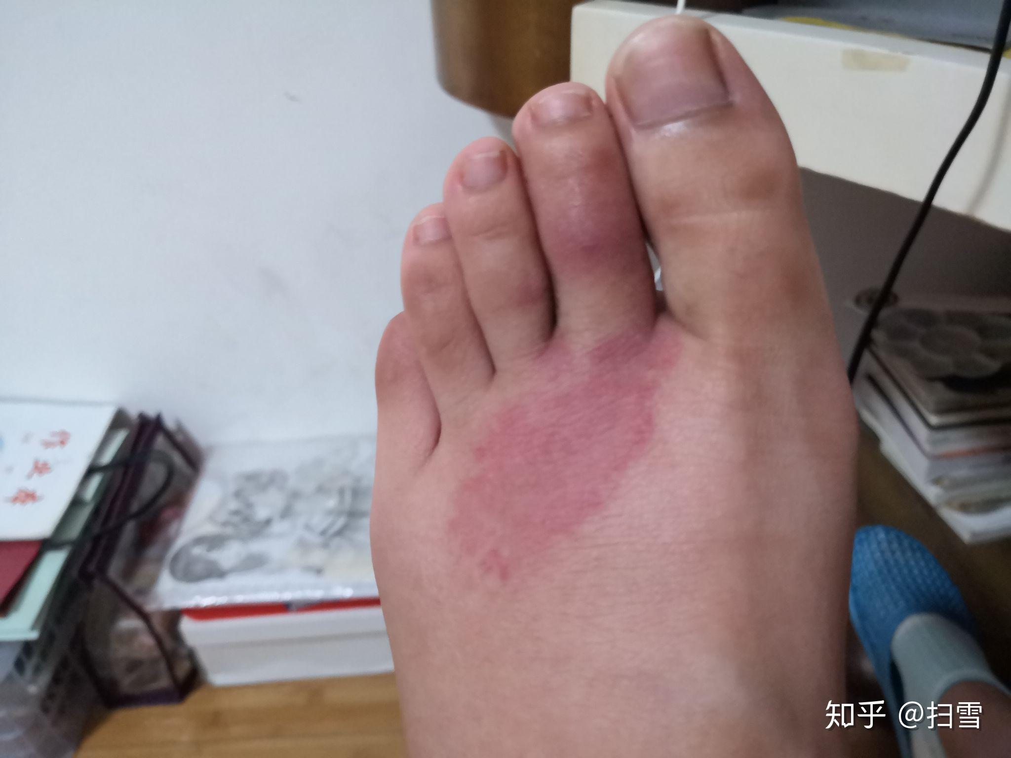 我被蜜蜂蛰了过敏了成这样正常吗