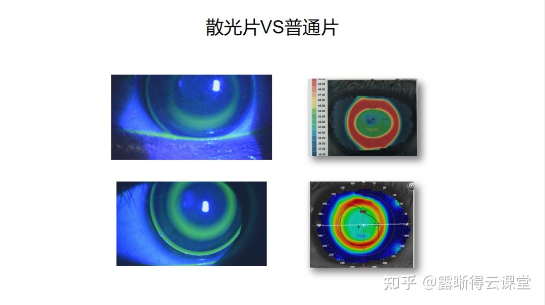 露晰得角膜塑形镜降幅图片