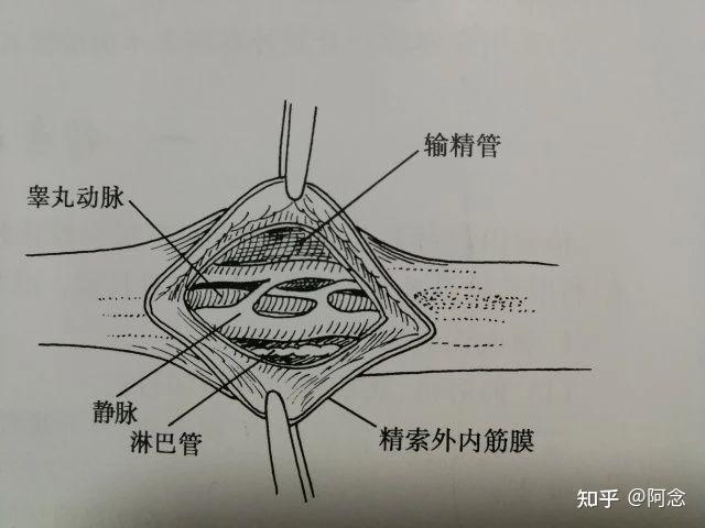 (2)术中能清楚识别,结扎所有曲张的精索内静脉,甚至曲张的输精管静脉