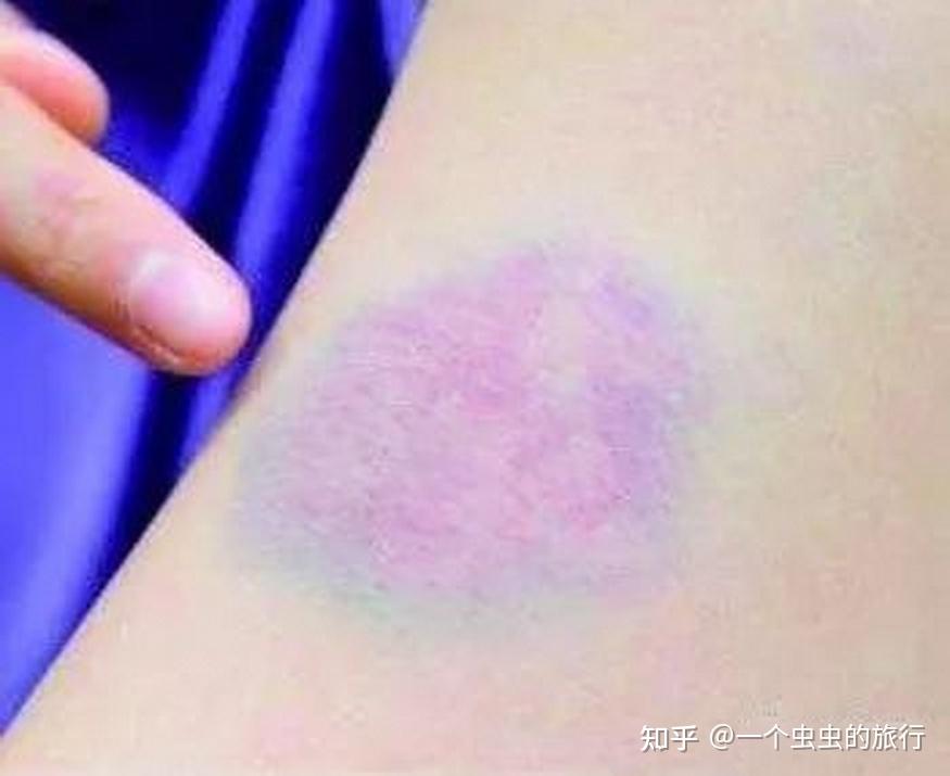 碰伤的地方为何会发青发紫 - 知乎