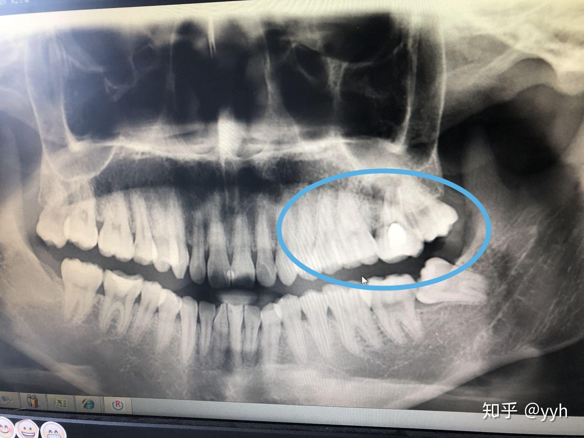请问右上房的牙齿有牙槽骨吸收的情况吗