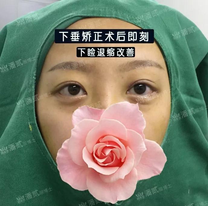 反人类下睑下至手术卧蚕丧失眼睑退缩睑外翻不舒服加老10岁