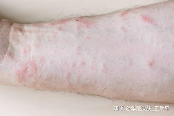 特应性皮炎和湿疹有什么区别?从五个方面区分! - 知乎