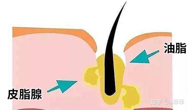 你是如何调理好脂溢性皮炎的? - 知乎