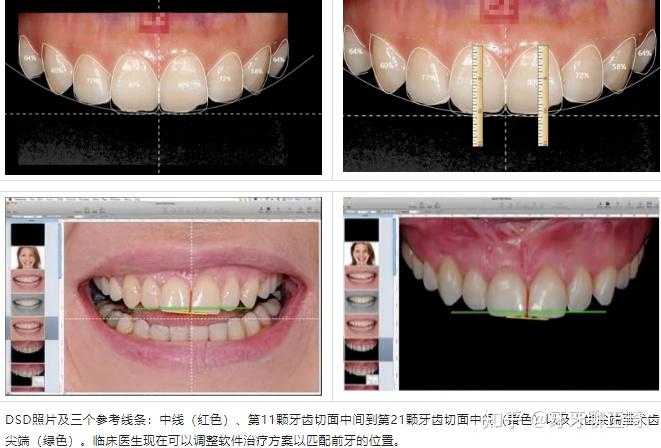 微笑线设计是什么鬼？怎么都在做，对牙齿有损伤吗？ - 知乎