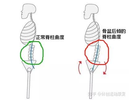 骨盆后倾该怎么办 知乎