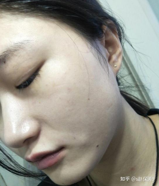 敏感肌红血丝怎么修复