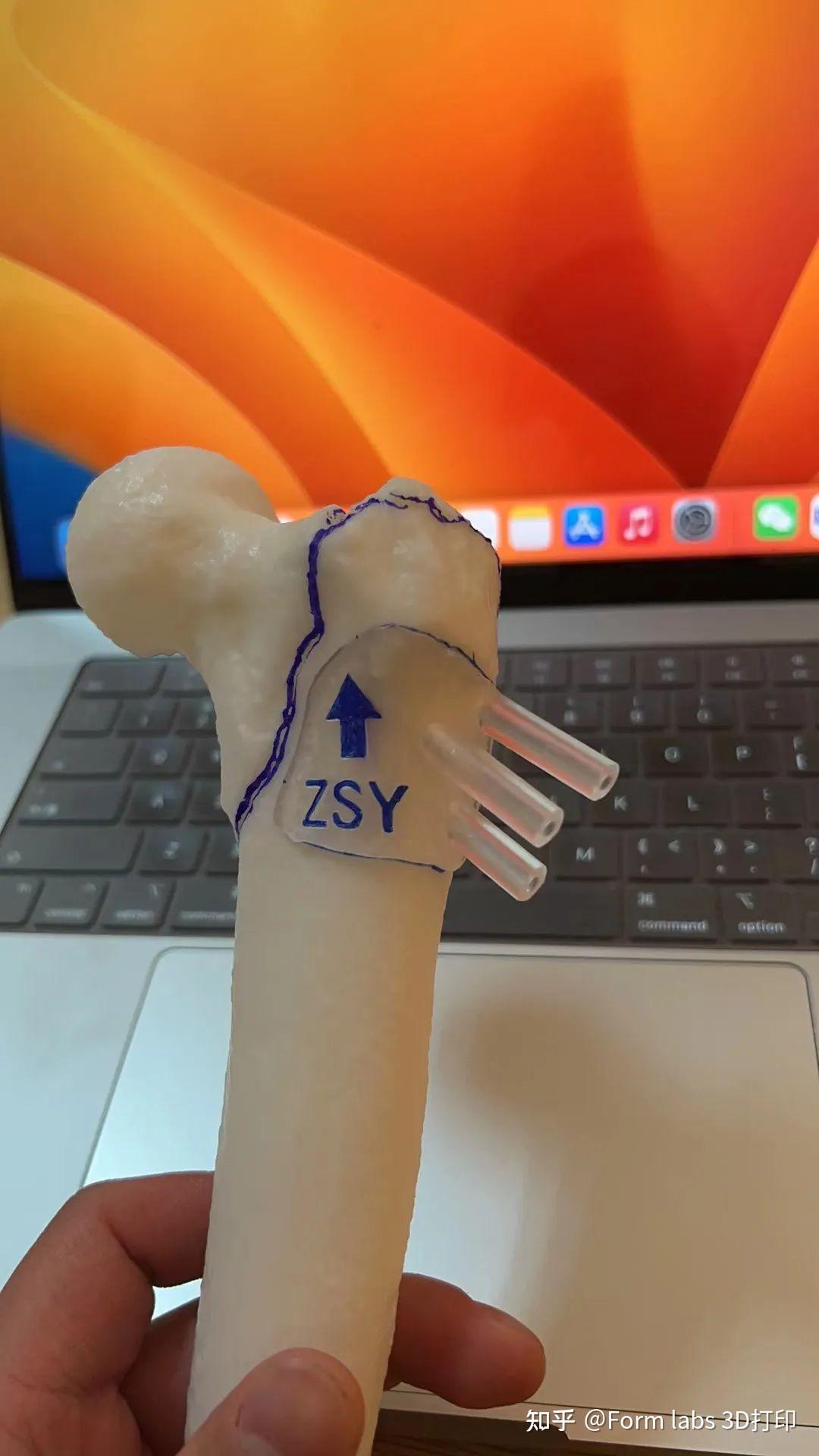 3D打印手术导板在三甲医院应用实例:高效、精确匹配不同手术类型 - 知乎