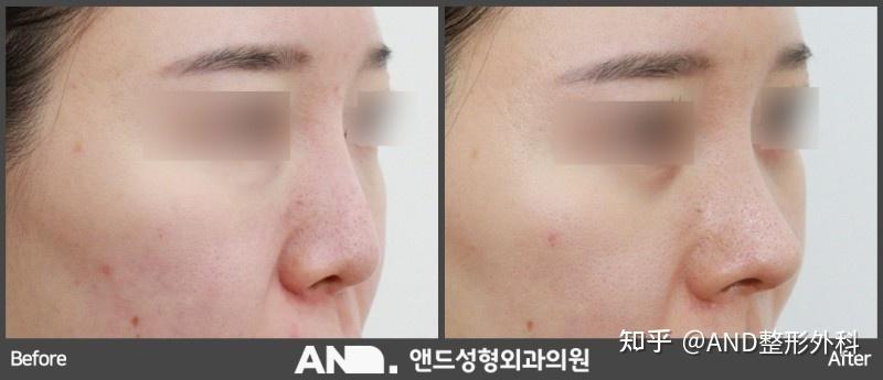 介绍使用3D量身定制式假体改善塌鼻、长鼻的方法/新论岘塌鼻整形 - 知乎