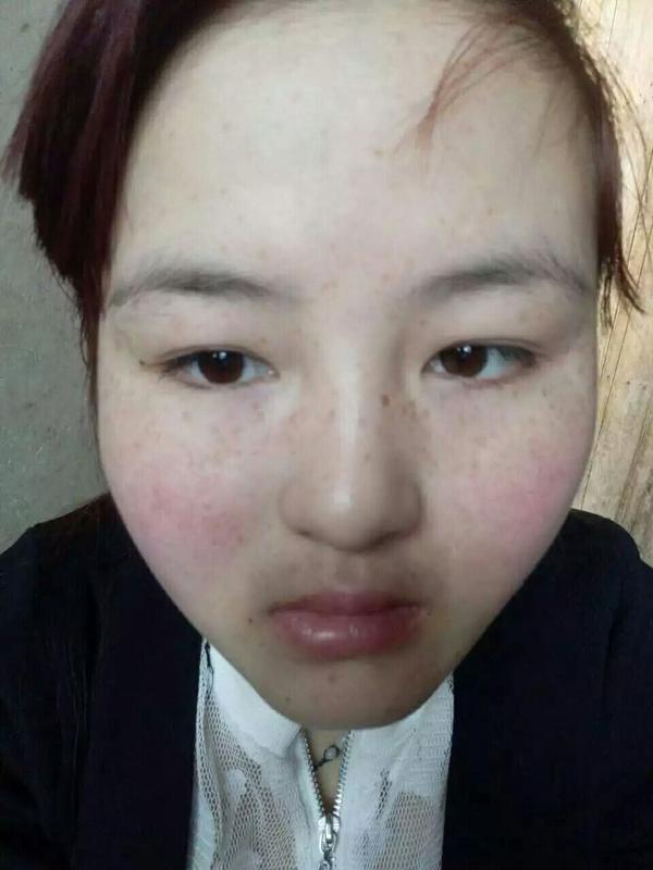 请问遗传性雀斑可以去掉吗 激光容易反弹吗? 纠结…?