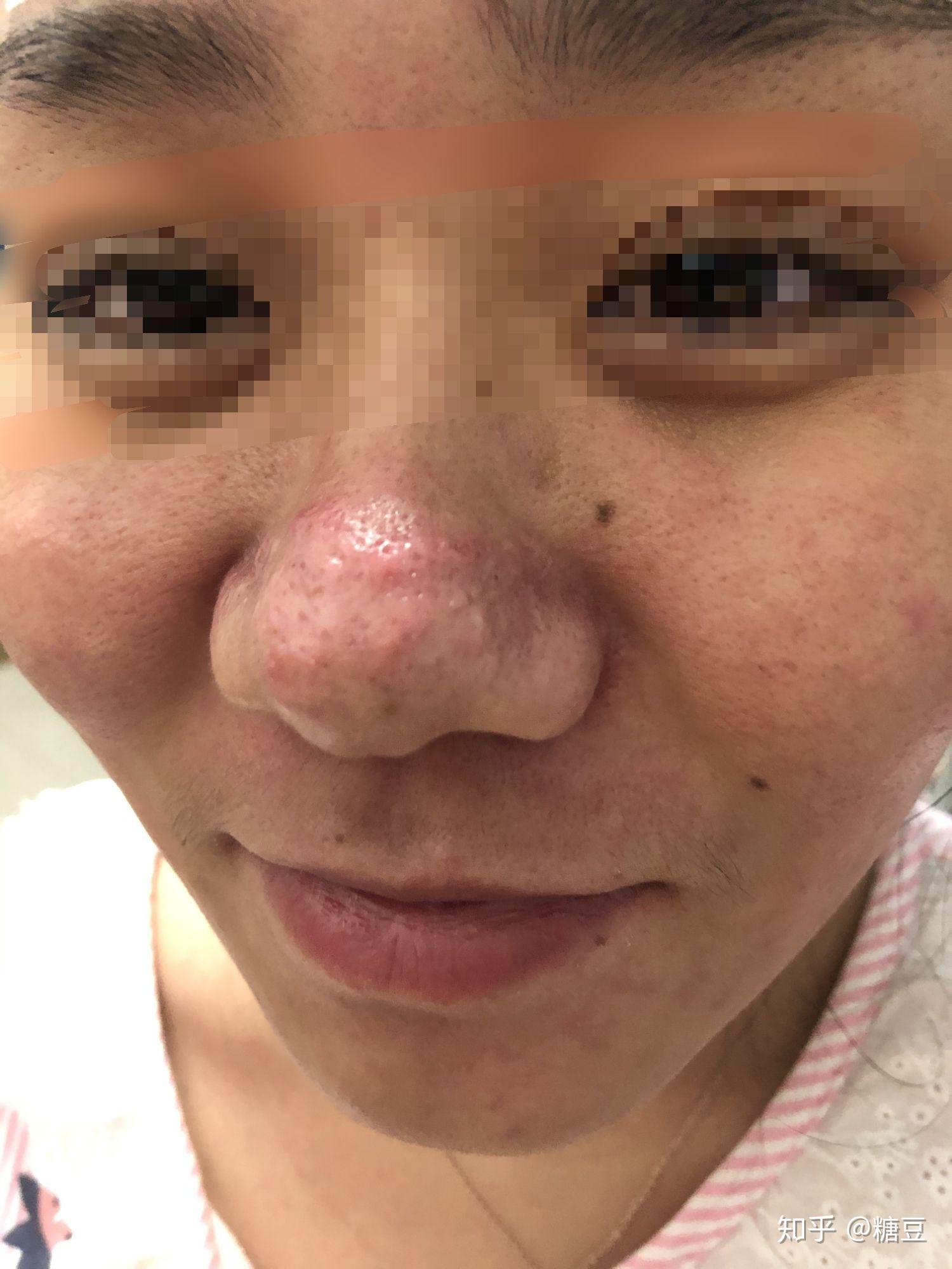 酒糟鼻点阵激光记录 - 知乎