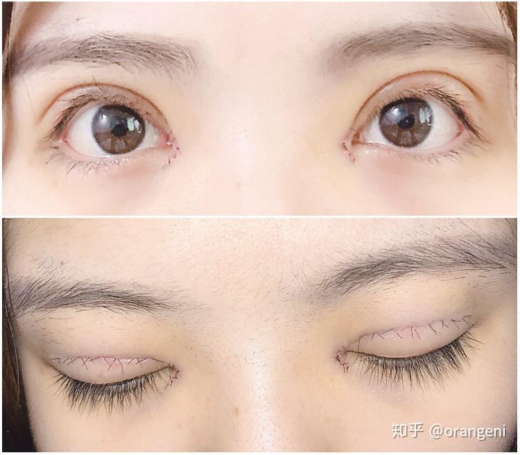 成都全切双眼皮 开眼角 提肌的小日记 - 知乎