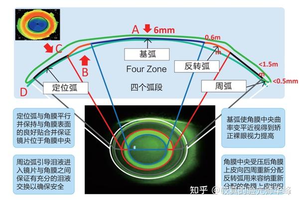 离焦镜片有用吗?不同离焦镜片的离焦量该如何选择? - 知乎