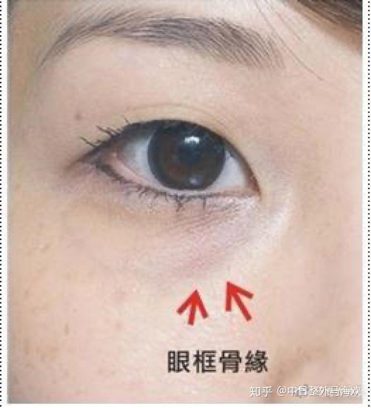泪沟的形成原因及泪沟的治疗方法 - 知乎
