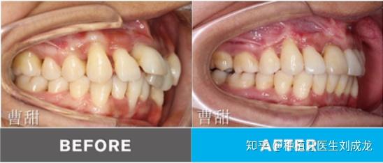 北京大學口腔正畸學博士曹甜 正畸案例