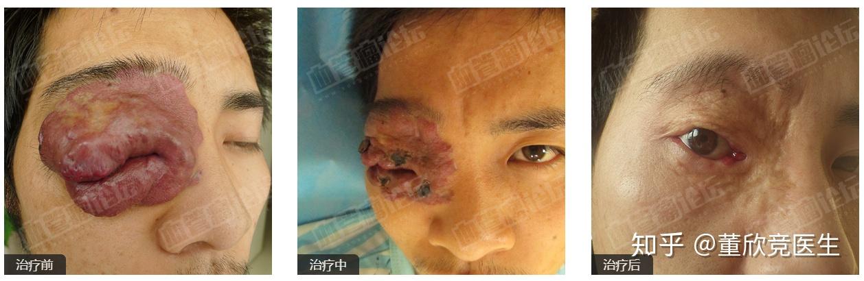 董欣竞医生 科普 [005期] 脉管畸形分类 - 知乎