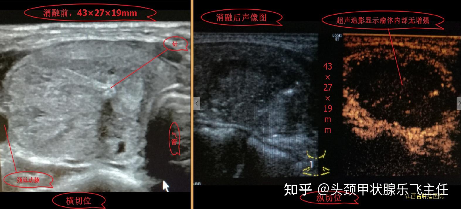 典型病例45釐米甲狀腺腫瘤消融後一年的演化過程