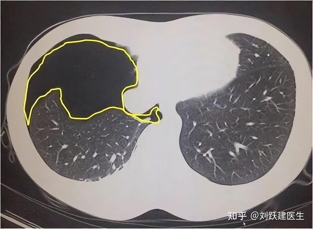 肺泡图片真实图片