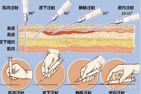 腹腔注射药物吸收原理图片