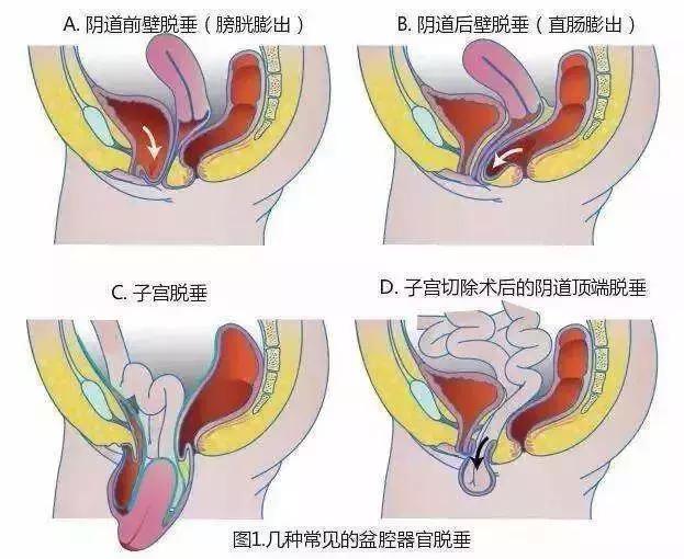 而這些問題往往有:陰道前壁膨出,陰道後壁膨出,子宮脫垂,壓力性尿失禁