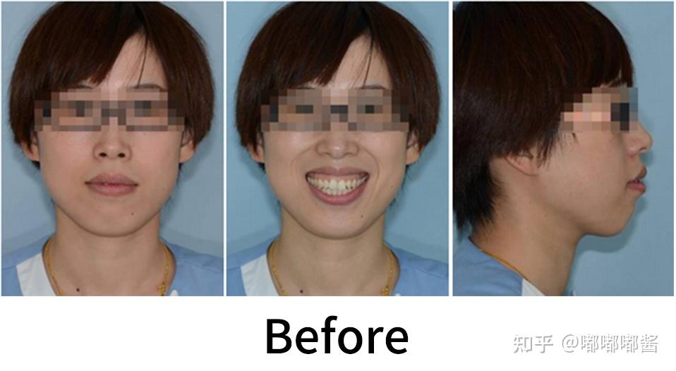 正畸案例分享丨高角前突露龈笑案例
