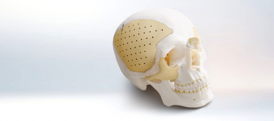 解锁peek材料颌面修复应用二颌面缺损重建