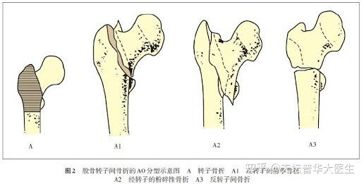 髋部骨折与脱位 - 知乎