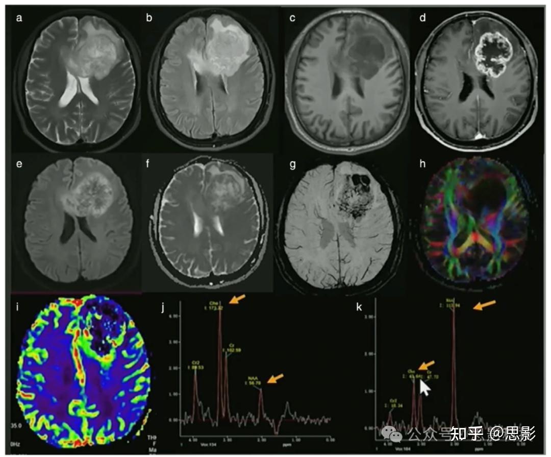 成像大脑之火（神经炎症） - 知乎
