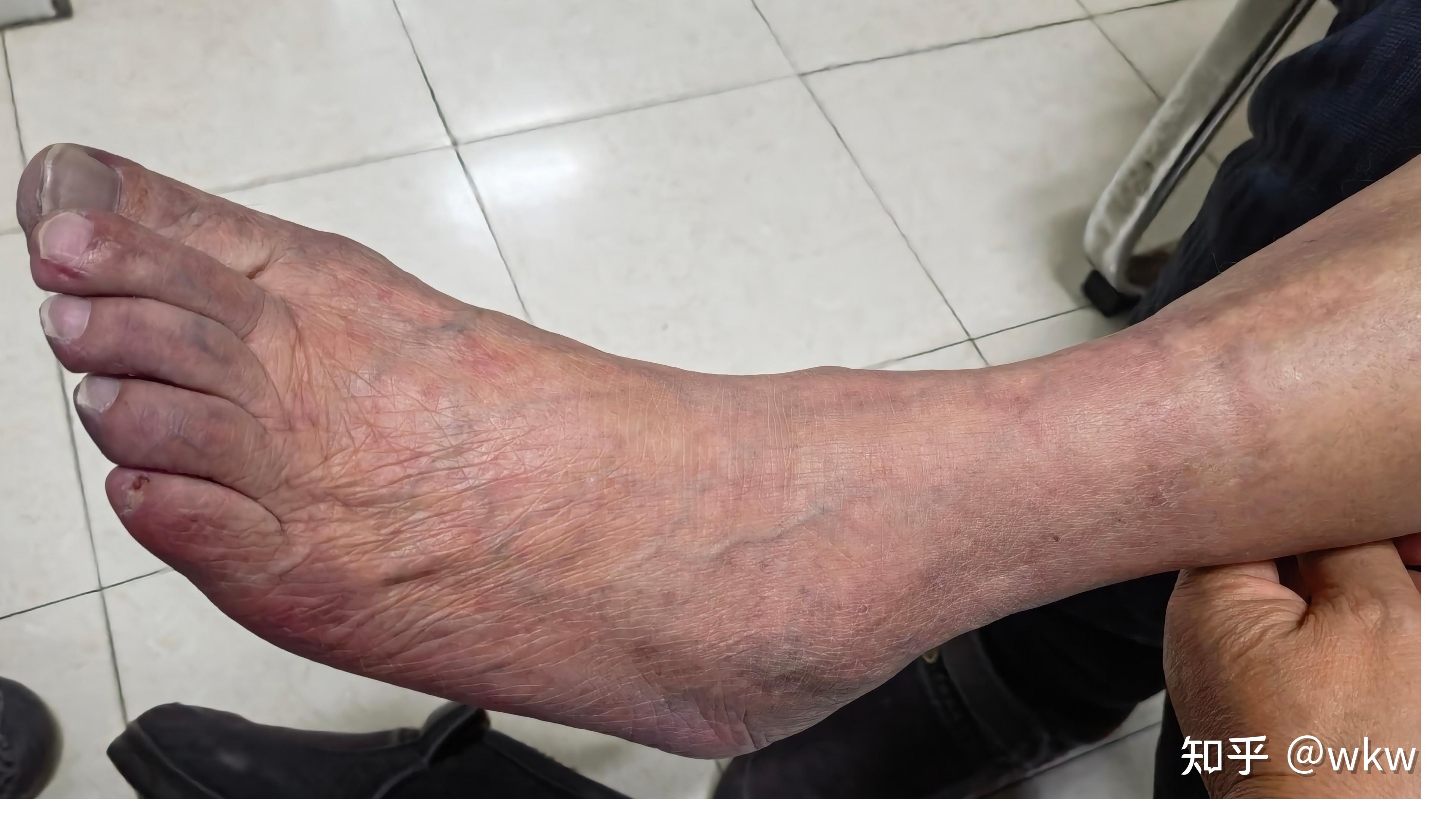 急性下肢动脉栓塞手术前后表现1