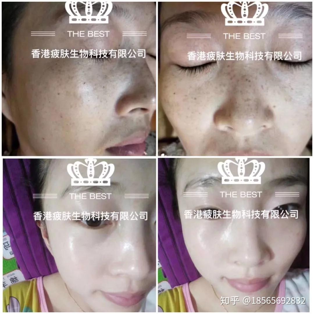 四雅教您瑜伽 祛斑妊娠纹