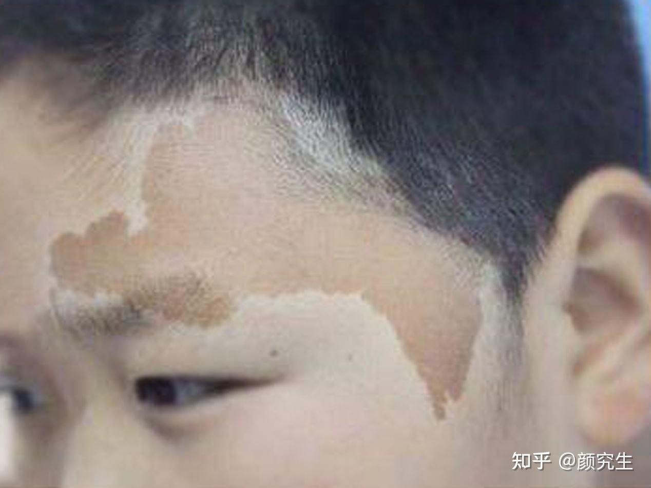分享一下在上海九院激光祛疤的经历 - 知乎