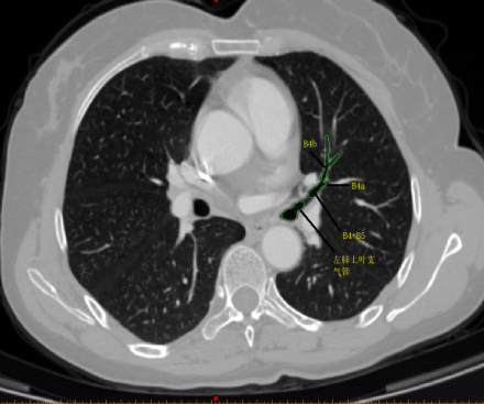 背段气管发出层面左肺上叶气管的辨认还是比较简单的,主要根据气管的