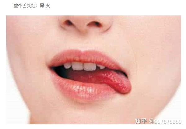 望 闻 问 切,阴虚阳虚气虚血虚上火用要辩证舌头治疗 - 知乎