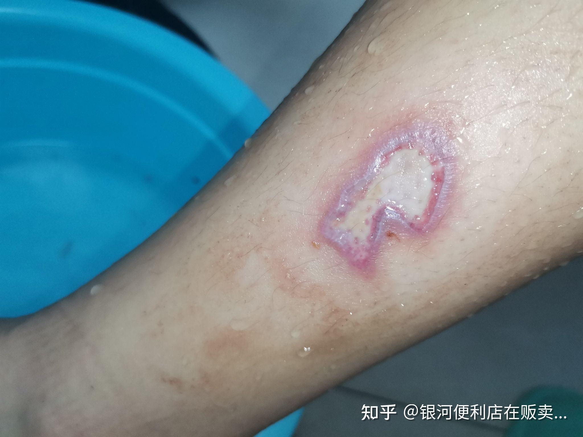 睡着时被热水袋烫伤一小块怎么解决