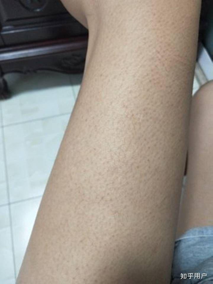 鸡皮肤严重还能治好吗(鸡皮肤严重还能治好吗图片)