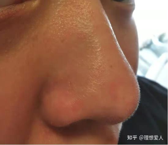 我应该拿这个巨大的黑头怎么办具体咋样去掉