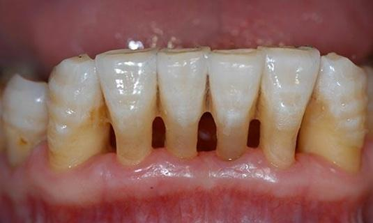 重度牙周炎牙齿松动怎么办只能拔掉了吗