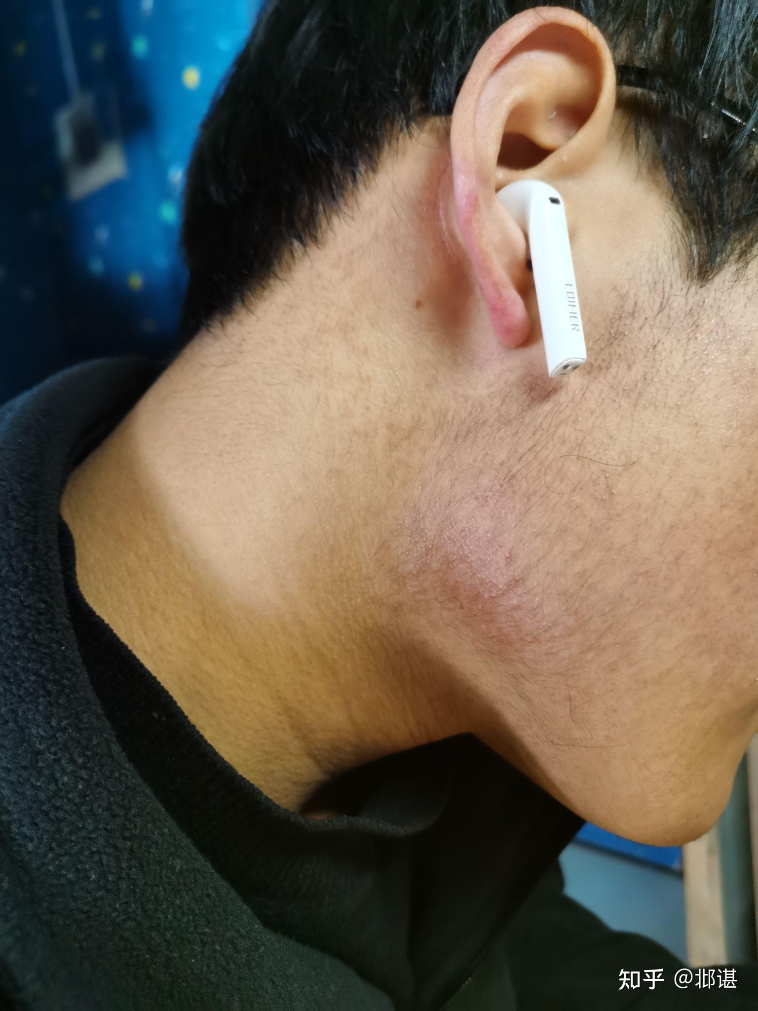 脸拔毛鸡皮肤(公鸡拔毛后的皮肤)