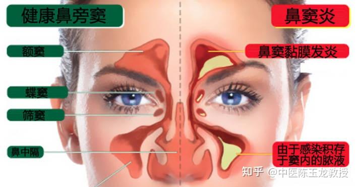 鼻炎鼻窦炎久治不愈?送你一方,清胆宣肺通鼻窍,搞定鼻炎不反复 - 知乎