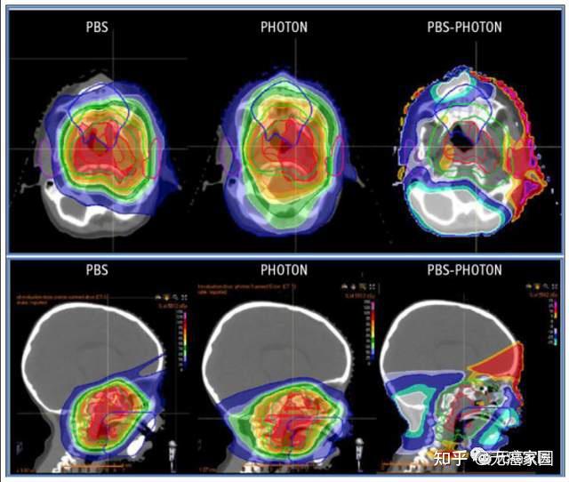 強推兒童患上膠質瘤顱底腫瘤髓母細胞瘤顱咽管瘤首選質子治療準沒錯