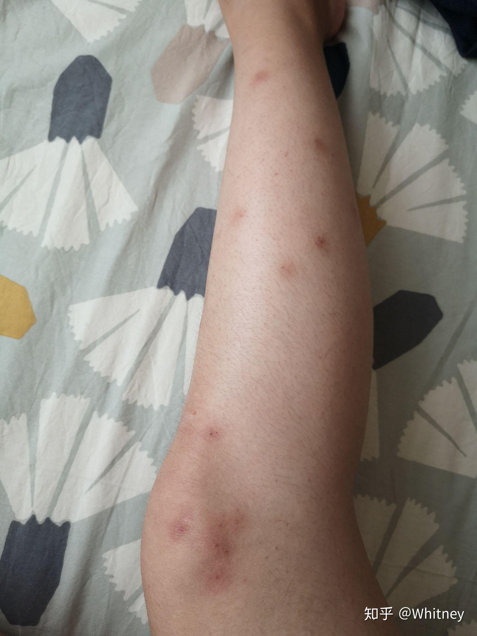 虫咬性荨麻疹怎么治疗图片