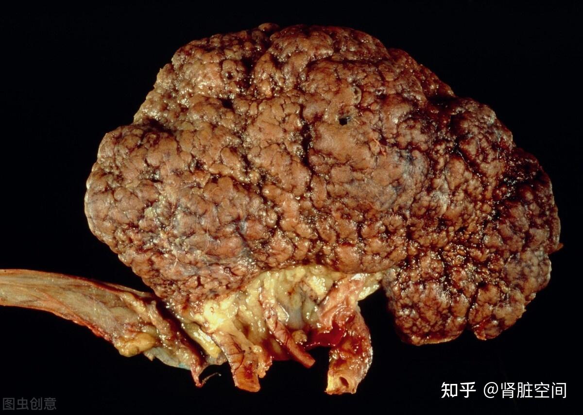 间质性肾炎 zhuanlan.zhihu.com