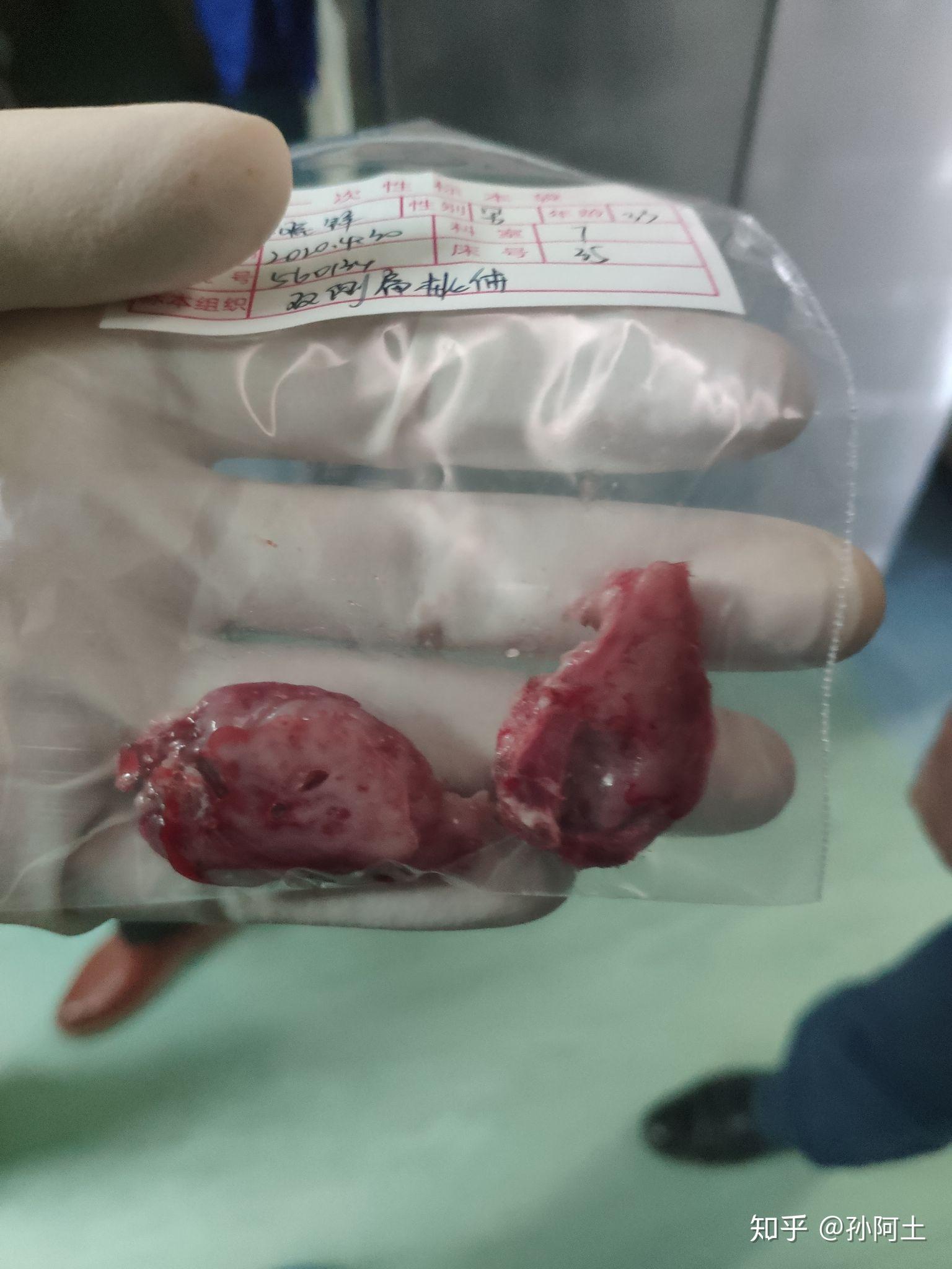 扁桃体摘除手术儿子图片