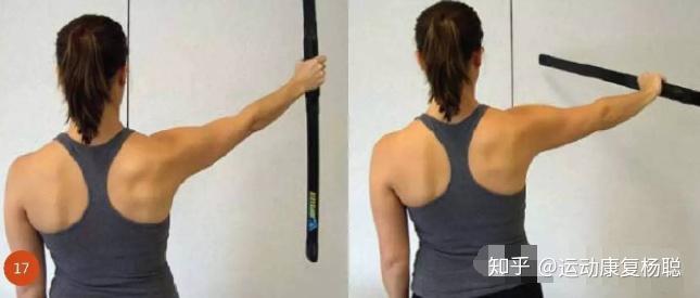 肩痛之肩峰撞击综合征的运动康复