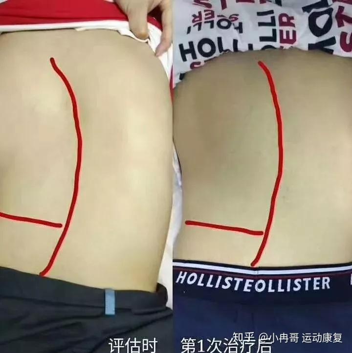 关于脊柱侧弯,你了解几分?