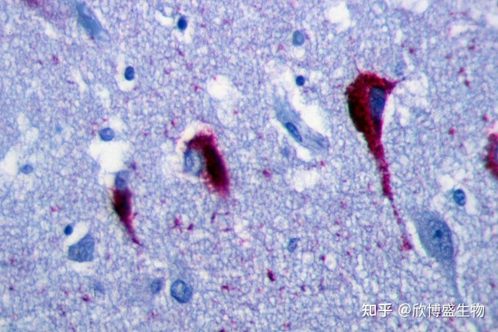 Tau蛋白聚集和阿尔茨海默氏症 知乎