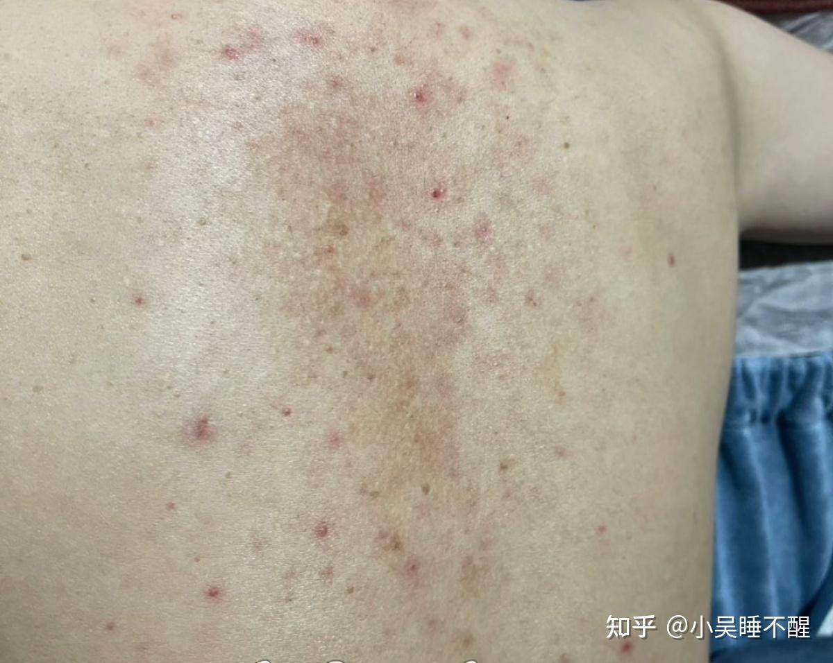 背上长痘比较严重,有什么比较快的方法吗? - 知乎