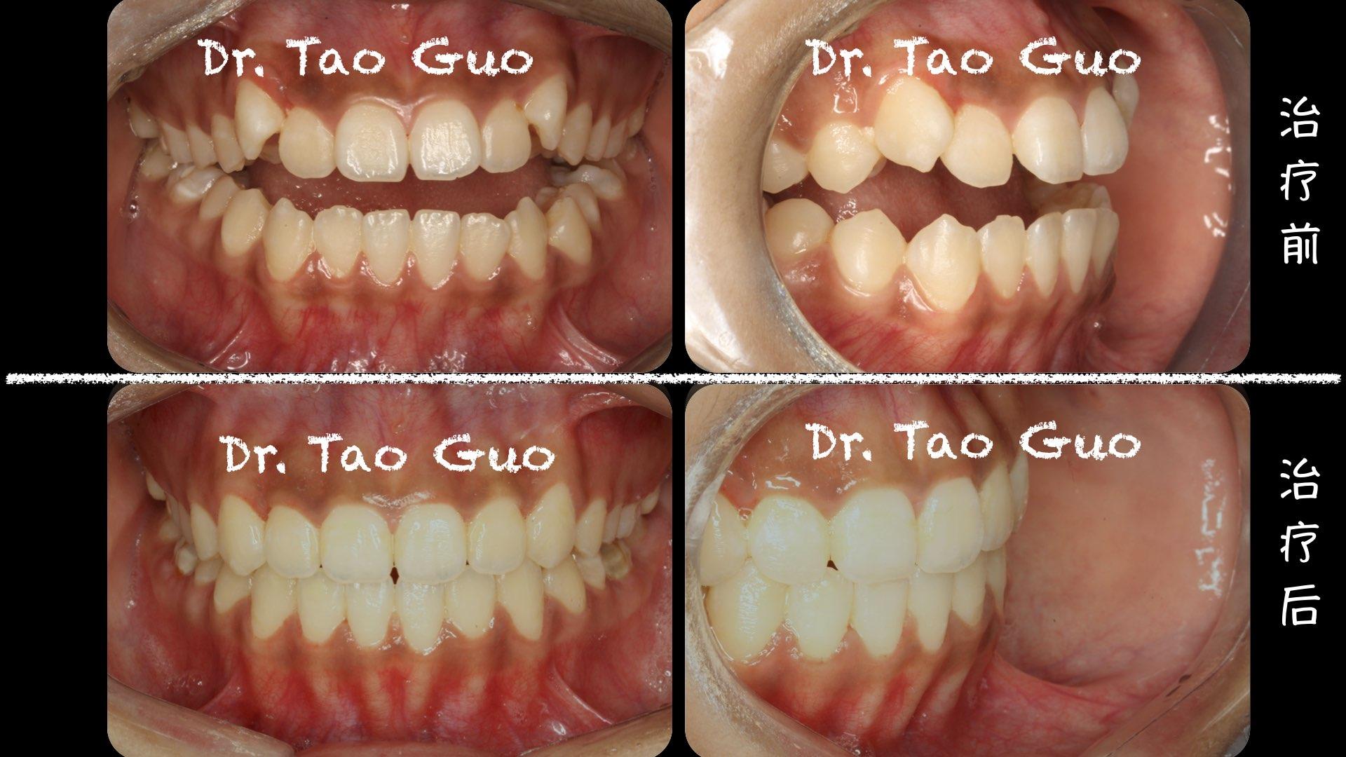 青少年开合矫正案例