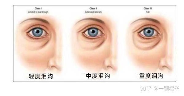 眼部问题如何解决| 黑眼圈、眼袋、泪沟傻傻分不清 - 知乎